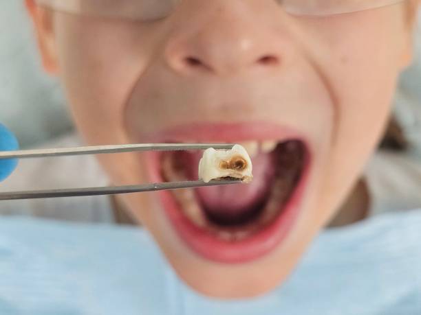 Best Emergency Root Canal Treatment in Valley Springs, CA